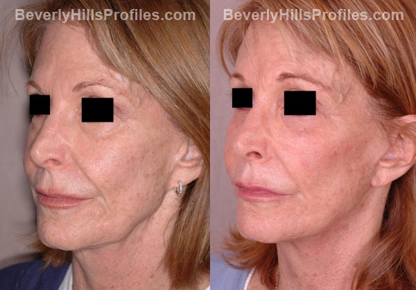 oblique view Female patient before and after Facelift