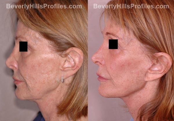 side view Female patient before and after Facelift
