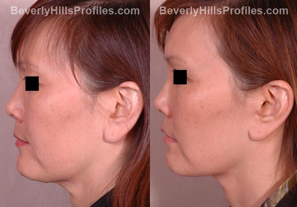 side view patient before and after Facelift