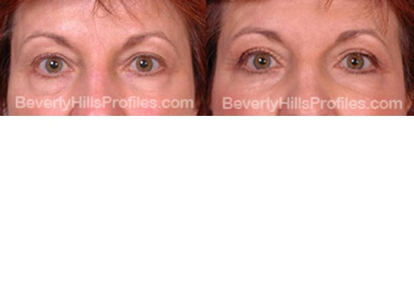 front view, before and after Facial Fat Transfer Procedures