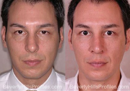 Male patient before and after Facial Fat Transfer - front view