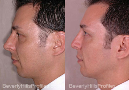 Male patient before and after Facial Fat Transfer - oblique view