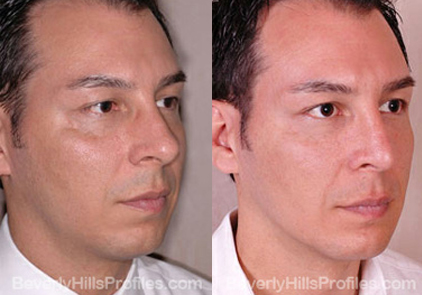 Male patient before and after Facial Fat Transfer - side view