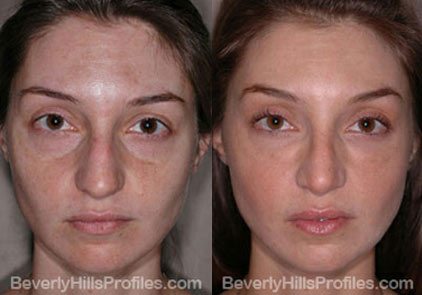 Female patient before and after Facial Fat Transfer - front view