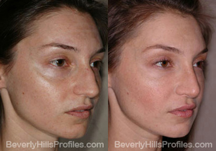 Female patient before and after Facial Fat Transfer - oblique view