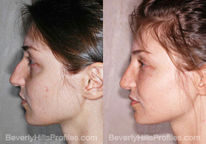 Female patient before and after Facial Fat Transfer - side view