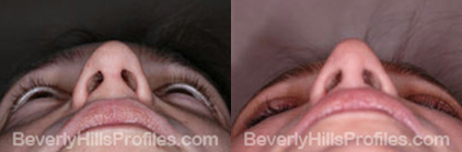 Female patient before and after Facial Fat Transfer