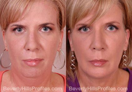 Female before and after Facial Fat Transfer - front view