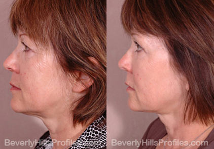 Female before and after Facial Fat Transfer Procedures - side view