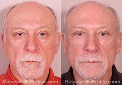 Male face, before and after Eyelid Lift treatment, front view, patient 2