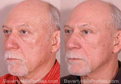 Male before and after Eyelid - oblique photos