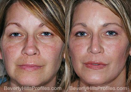 Female patient before and after Facial Fat Transfer Procedures