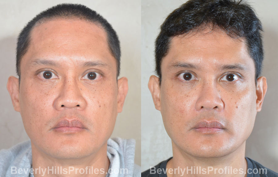 Male patient before and after Facial Fat Transfer - front view