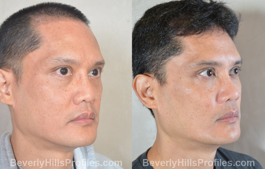 Male patient before and after Facial Fat Transfer - oblique view