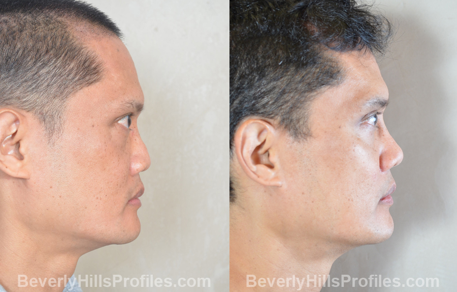 Male patient before and after Facial Fat Transfer - side view