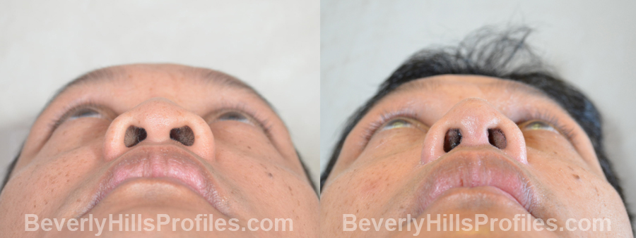 Male patient before and after Facial Fat Transfer