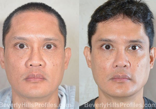 Male patient before and after Facial Fat Transfer, front view