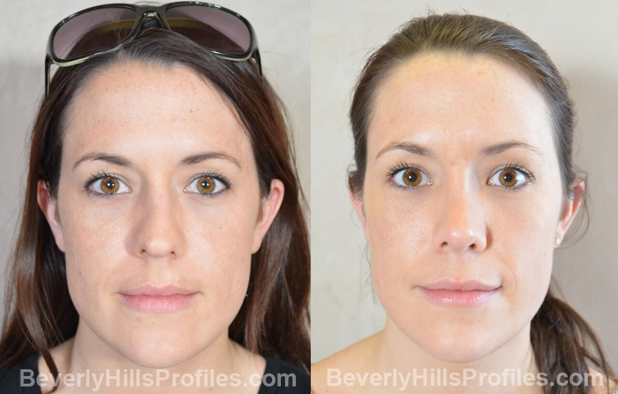 front view - Female patient before and after Facial Fat Transfer