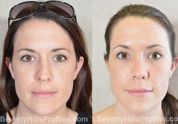 front view - before and after Facial Fat Transfer Procedures