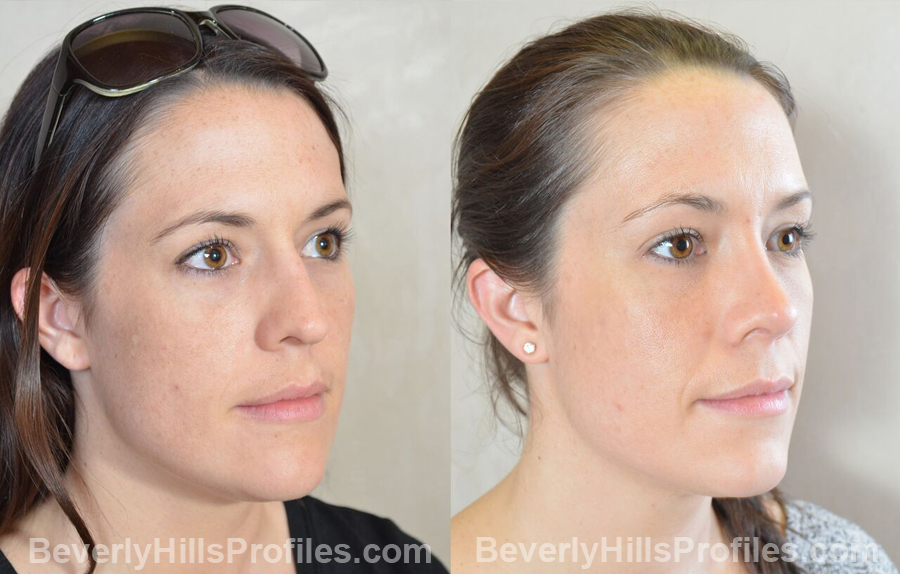 oblique view - Female patient before and after Facial Fat Transfer