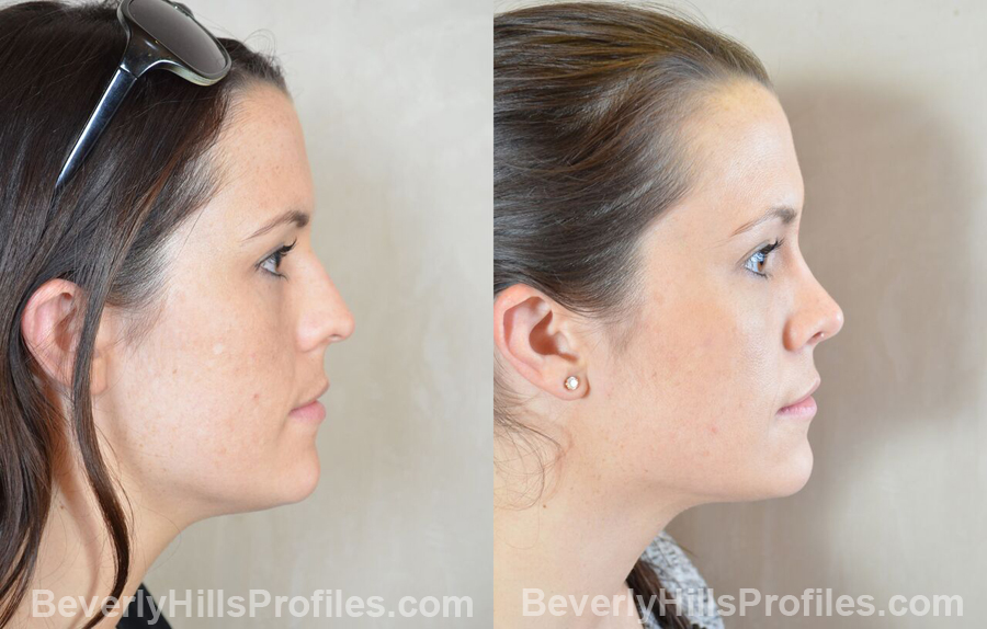 side view - Female patient before and after Facial Fat Transfer