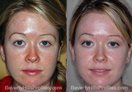 front view Female before and after Facial Peels
