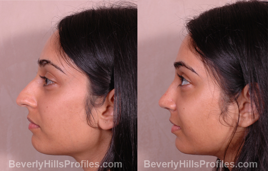 side photos Female patient before and after Rhinoplasty