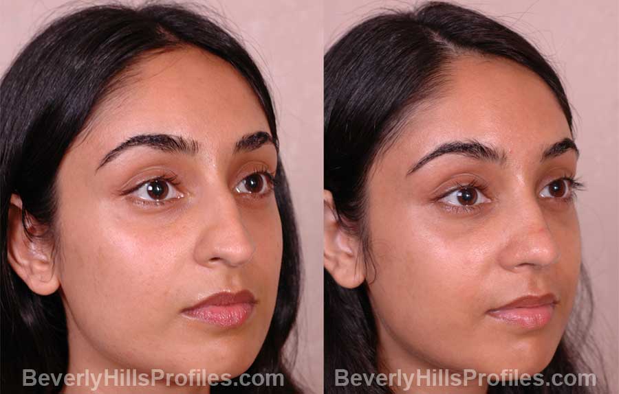 front photos Female patient before and after Rhinoplasty