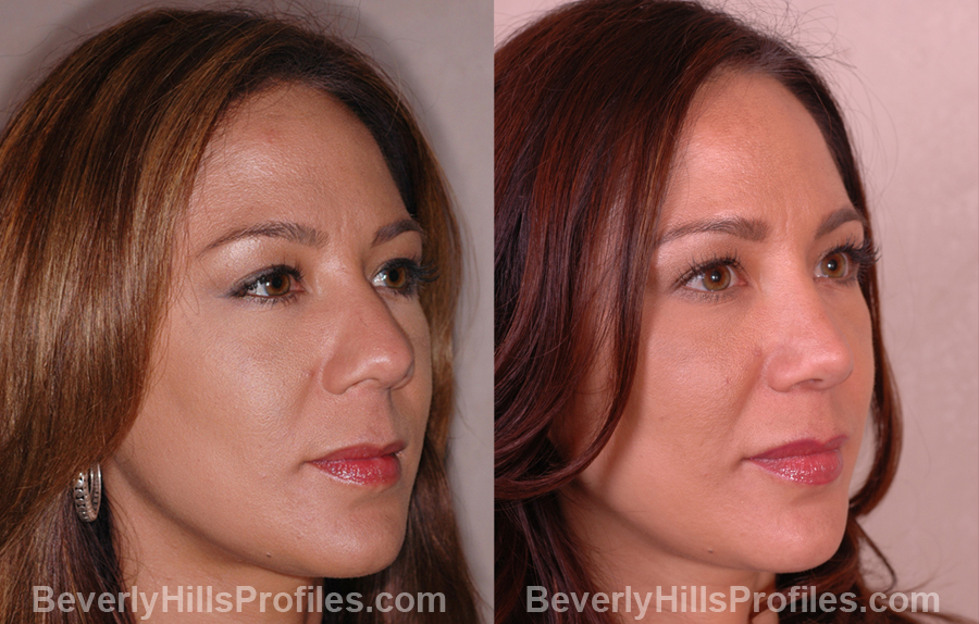 oblique photos, Female before and after Nose Job
