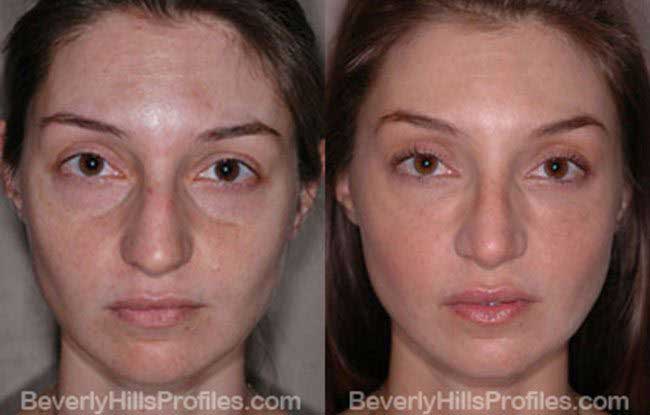 Meaning rhinoplasty Liquid Rhinoplasty