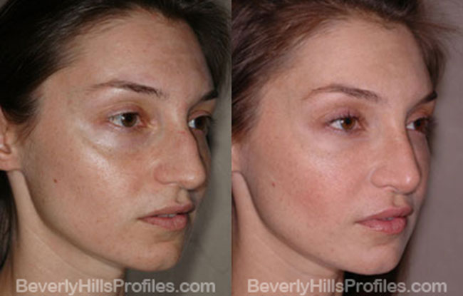 oblique photos - Female before and after Nose Job