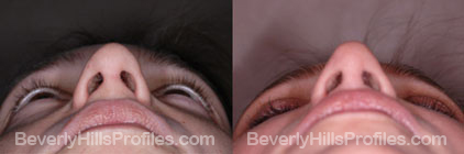 underside photos - Female before and after Nose Job
