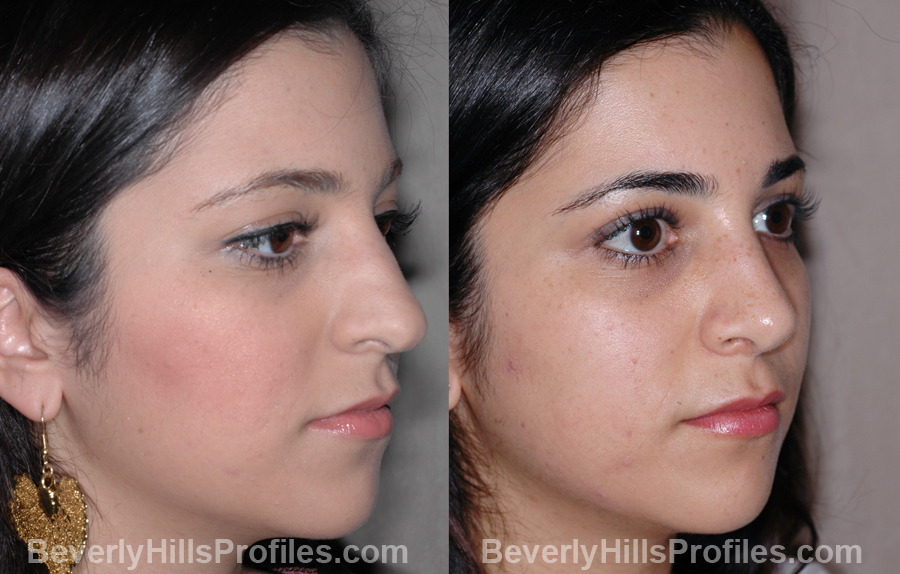 oblique view - Female before and after Nose Job