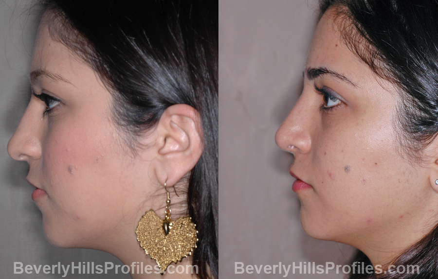 side view - Female before and after Nose Job