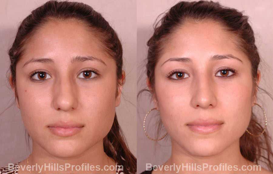 front view - Female before and after Nose Job