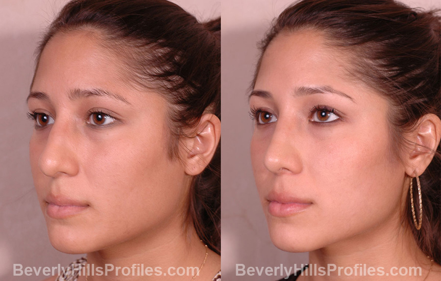 oblique view - Female before and after Nose Job