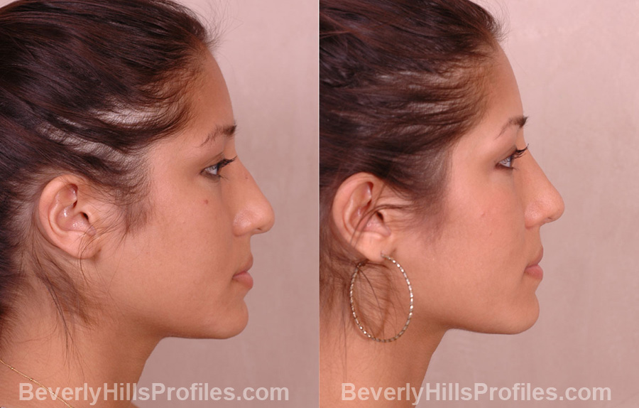 side view - Female before and after Nose Job