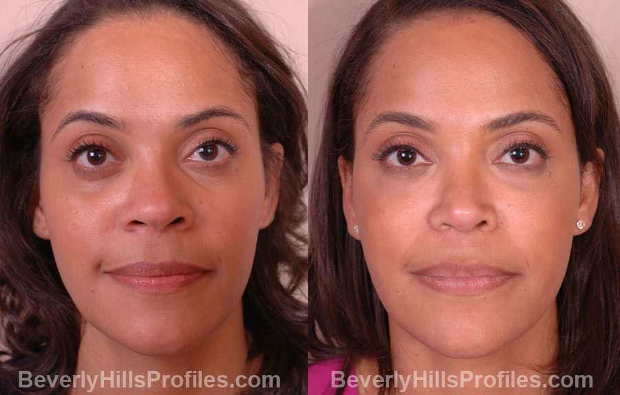 front view, Female patient before and after Nose Job