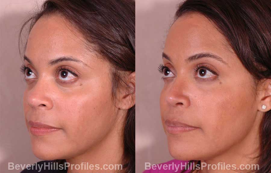 front view, Female patient before and after Nose Job