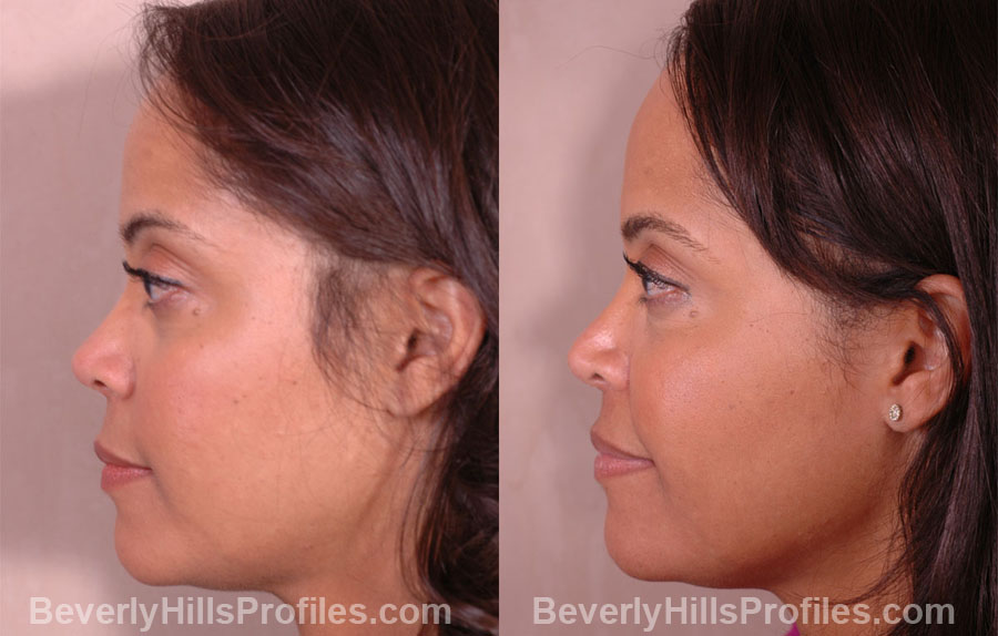 side view, Female patient before and after Nose Job
