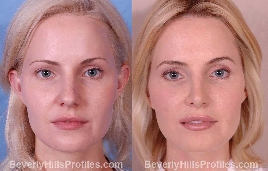 Female before and after Rhinoplasty - front view