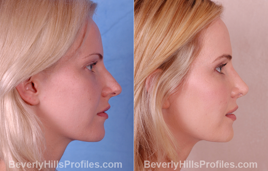 Female before and after Rhinoplasty - side view