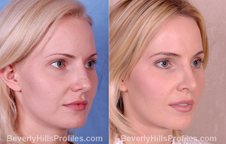 Female before and after Rhinoplasty - oblique view