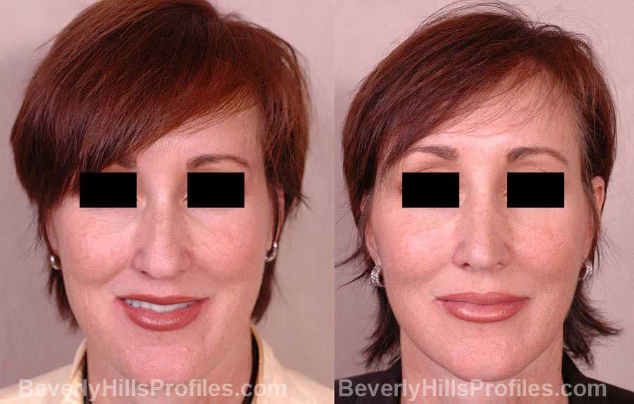 Female before and after Nose Job - front view