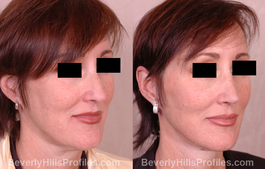 Female before and after Nose Job - oblique view
