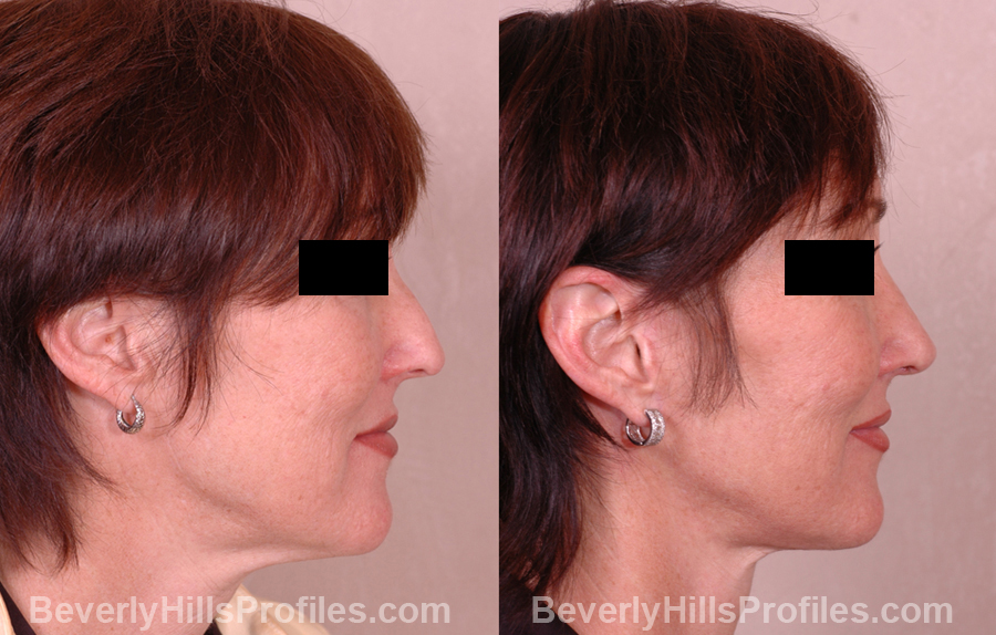Female before and after Nose Job - side view