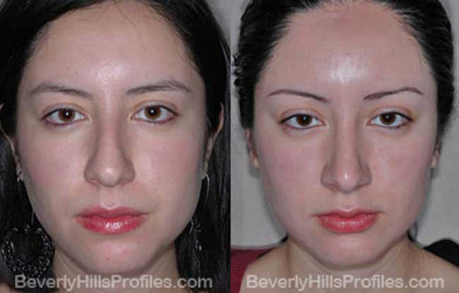 Female patient before and after Nose Job - front view