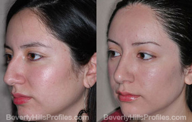 Female patient before and after Nose Job - oblique view