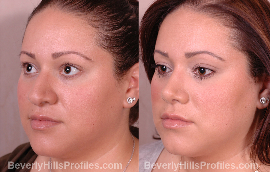 Female patient before and after Nose Job oblique view