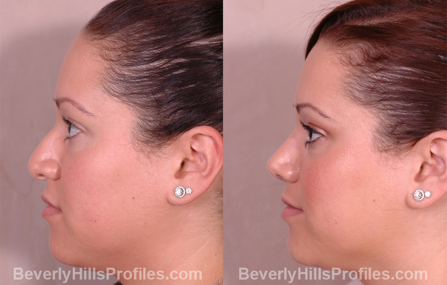 Female patient before and after Nose Job side view